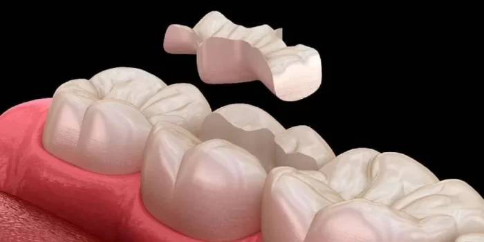 Керамические вкладки на боковые зубы