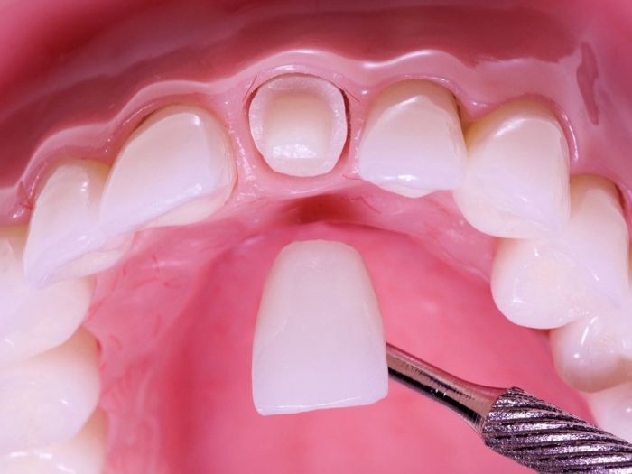 Установка коронки на зубы